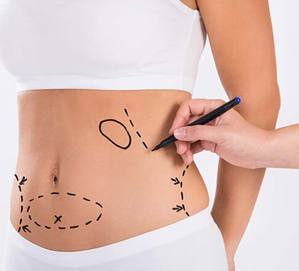 Abdominoplasty