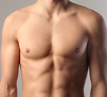 Gynecomastia