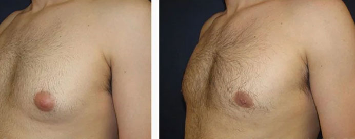 Gynecomastia Surgery Mumbai