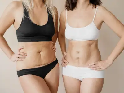 Before and after image of stretch mark removal through plastic surgery