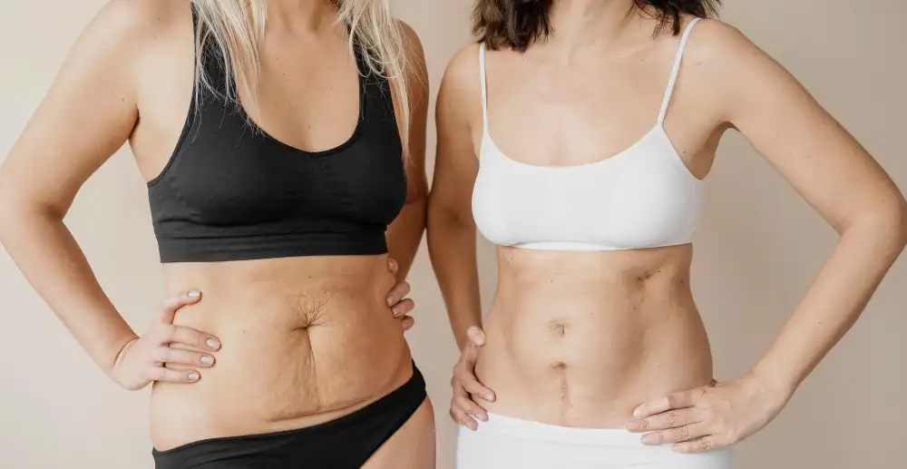Before and after image of stretch mark removal through plastic surgery
