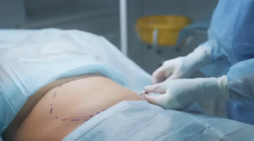 After Effects of Liposuction Surgery