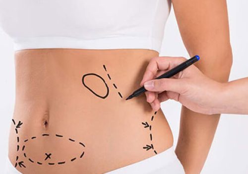 Abdominoplasty Abdominoplasty