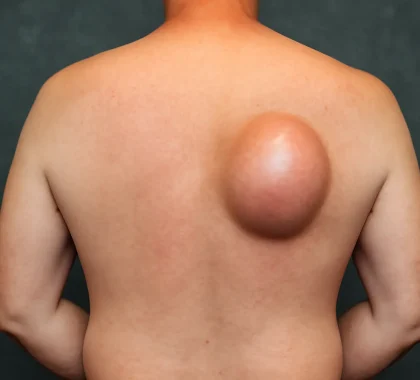 Lipoma Removal Lipoma Removal