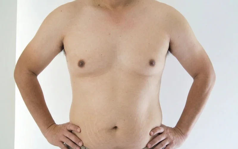 Gynecomastia
